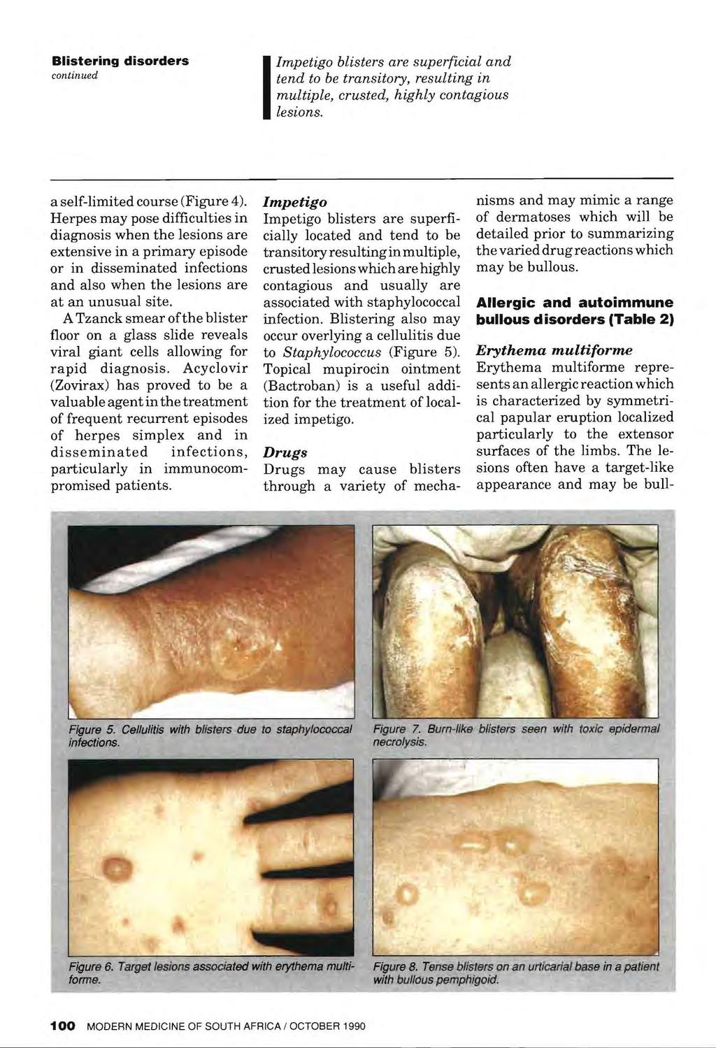 Impetigo blisters are superficial and continued I ten(i f0 transitory, resulting in multiple, crusted, highly contagious lesions. a self-limited course (Figure 4).
