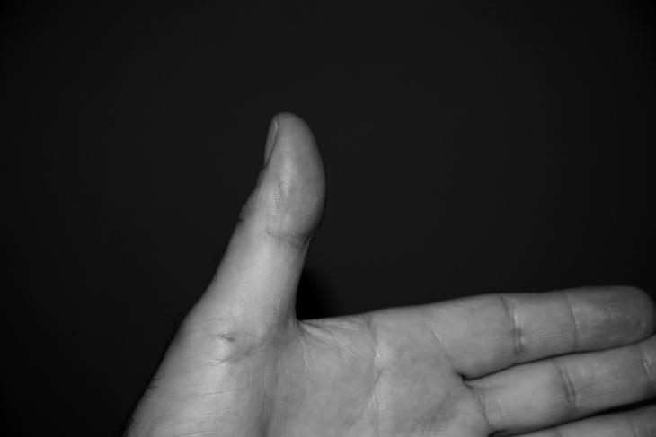 11 Thumb shape is controlled by a gene. The dominant allele, T, results in a normal thumb shape.
