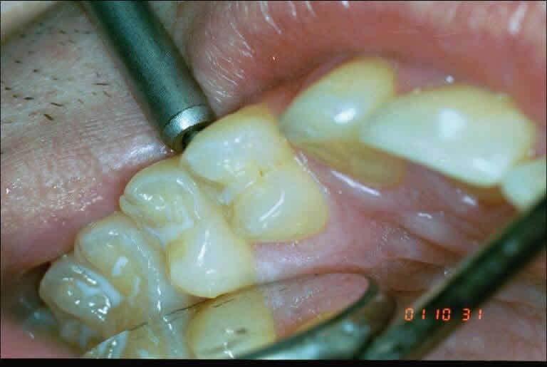 Dental Caries Diagnosis Visual
