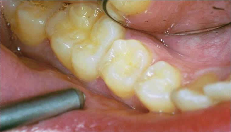 Caries Management Evaluate the outcome of the medical