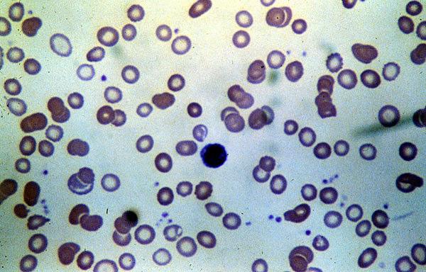 2 Iron deficiency anisocytosis poikilocytosis ก hypochromia