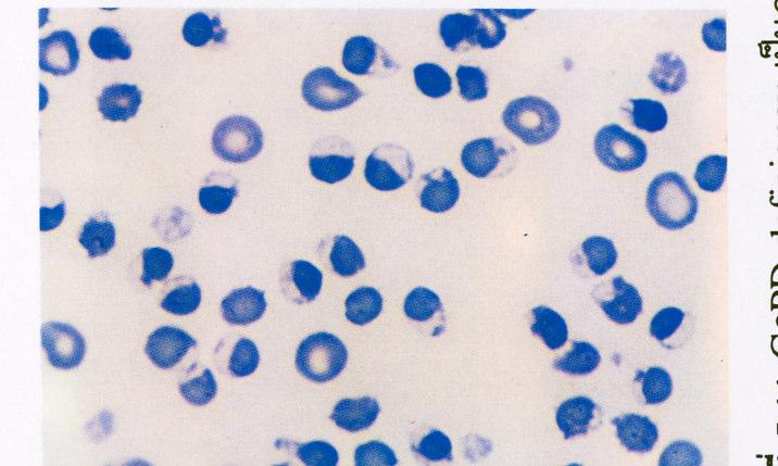 6 G-6-PD deficiency red cell with contracted