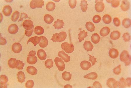 hemoglobin leakage 7 Microangiopathic hemolytic