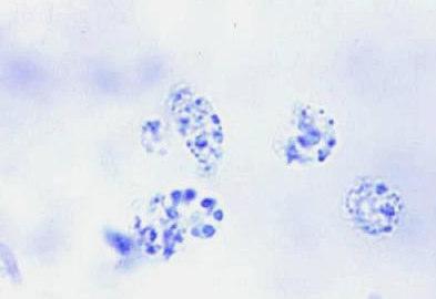 reticulocyte count (%) = reticulocyte x Hct Hct ก 9 Reticulocyte กก methylene blue