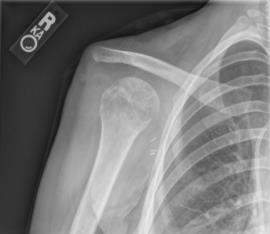 Case #4 Post-operative follow-up x-rays Red Flags New or old mass with rapid growth Within weeks or months is a