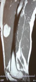 complaint: Mass in left thigh HPI: Healthy male with slowly enlarging mass in