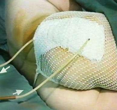 closure of wound after treatment, cleaning of wound from nonviable tissue, necrosis, pus: