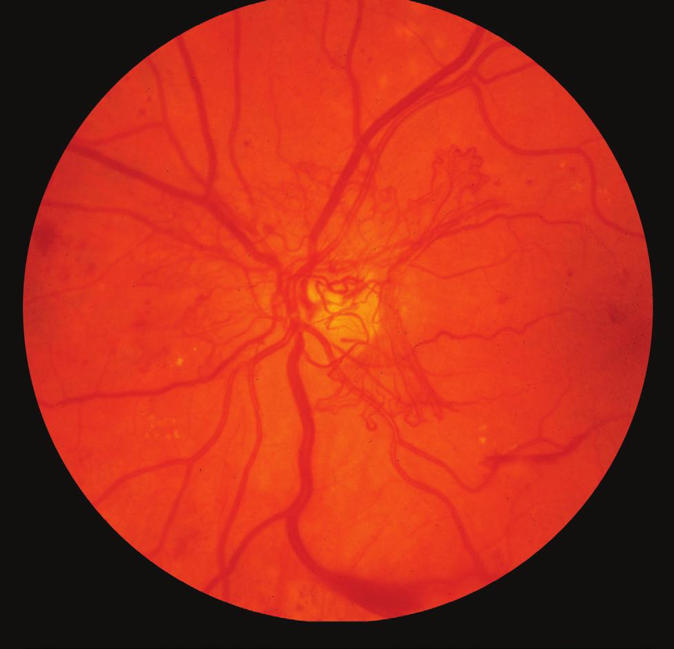 In addition to this exam, physicians use other tests to detect and manage diabetic retinopathy: An optical coherence tomography (OCT) test provides highly detailed cross-sectional images of the