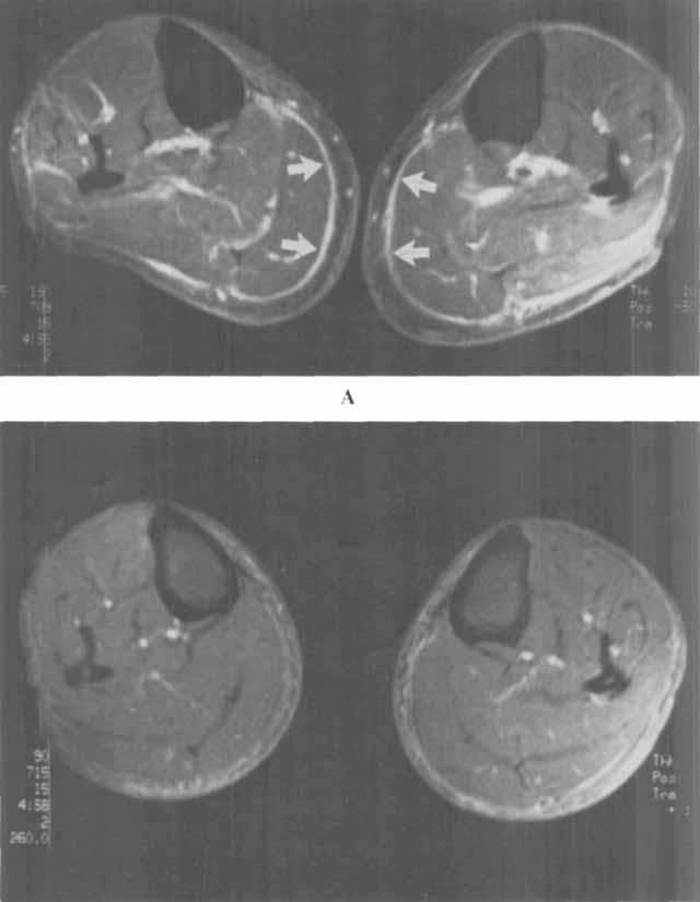 1604 L-SHIKH ET L Figure 2. Magnetic resonance imaging axial scans through the mid-calves of patient 1 before () and after () treatment.