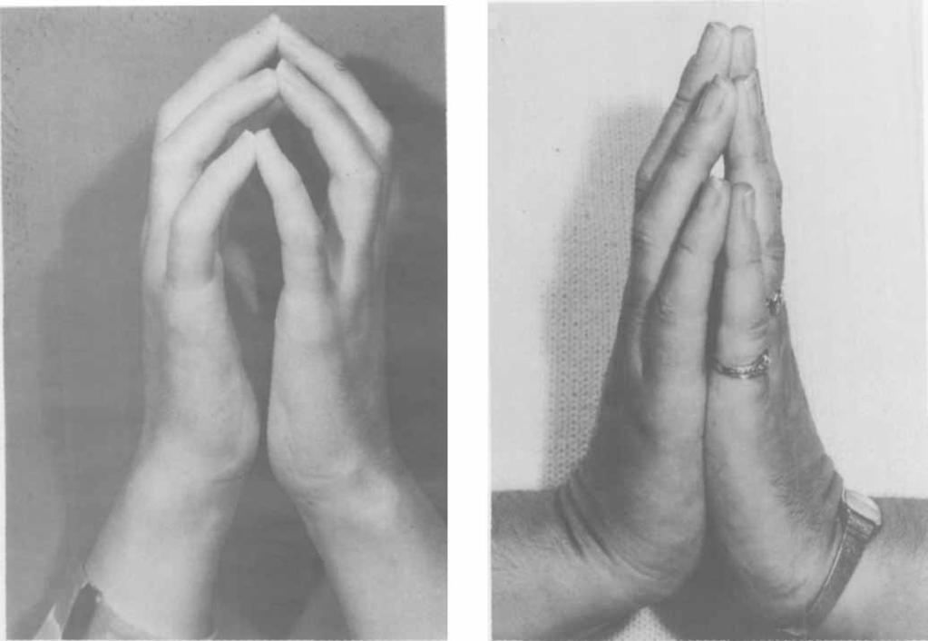 MRI FOR DIGNOSING EF 1605 Figure 3. Photographs of the hands of patient 2, before () and after () treatment.