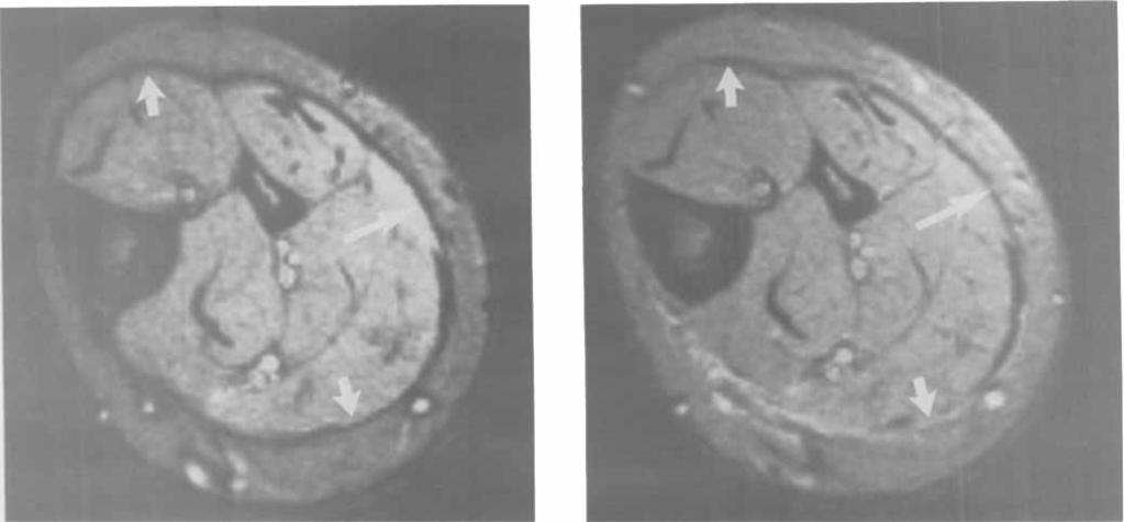 MRI FOR DIGNOSING EF 1607 Figure 5. Magnetic resonance imaging axial scans through the mid-calf of a normal volunteer.