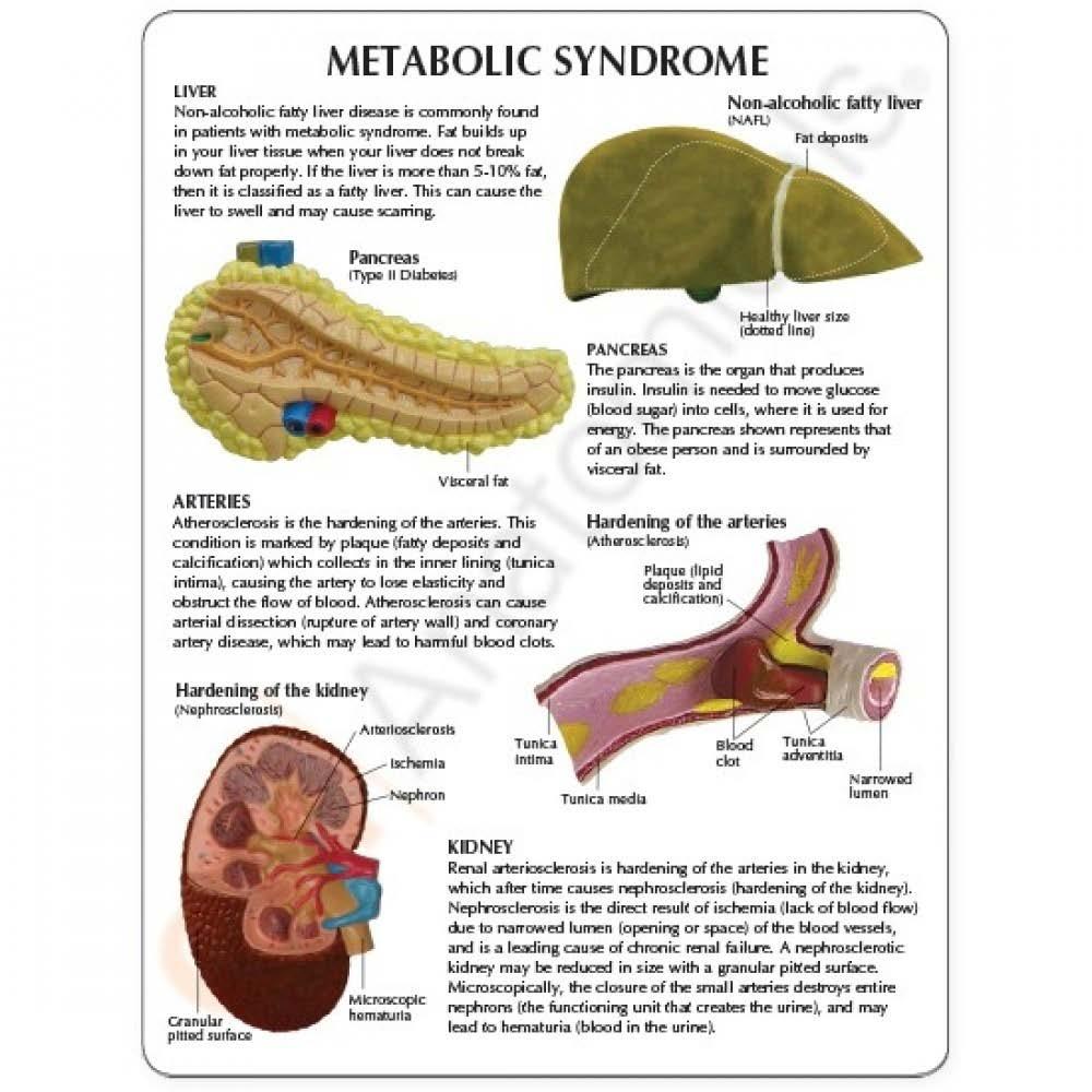 Summary Met abolic syndrome is a set of sympt oms that co-occur and increase the risk of CVD and