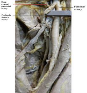 Picture 2 : Showing anomalous origin of Deep external Pudendal Artery from ProfundaFemoris artery Picture 3 : Showing normal origin of Deep external Pudendal Artery from