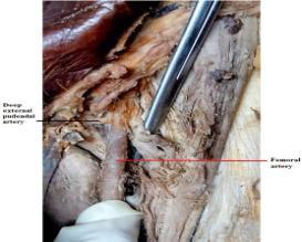 46%); while deep external pudendal artery was arising from arteriaprofundafemoris instead of the femoral artery.