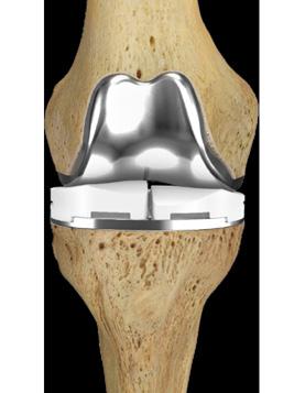 patient-specific implants and