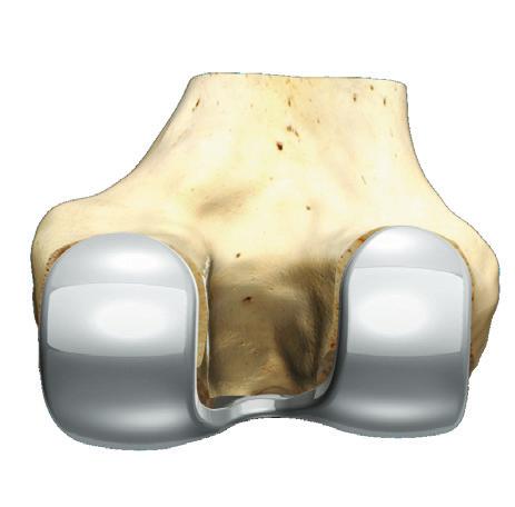 residual pain in total knee