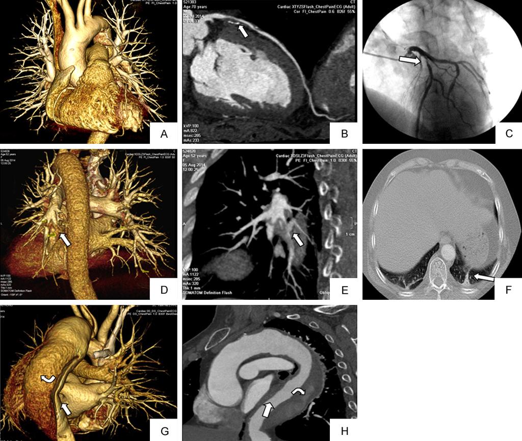 Figure 1. Imagine characteristics of coronary heart disease, Pulmonary artery embolism and aortic dissection. A-C. Coronary heart disease; A.