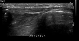 Ruptured rectus femoris muscle Ruptured rectus femoris muscle with retracted tendon Patellar Tendon Jumper s Knee Overuse syndrome due to sudden or
