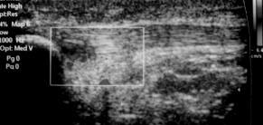 necrosis) and tear +/- secondary inflammatory response at patellar insertion Ultrasound features Hypoechoic thickening of the PT Loss of normal