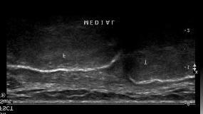 Medial meniscus pathology