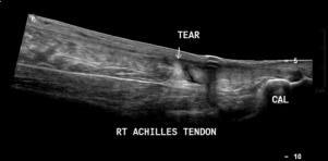 MUSCLE-APONEUROSIS TEAR Commonest site in the calf between the distal part of medial head of gastrocnemius and soleus muscle - Tennis leg Characteristic Pop Common in sports requiring jumps or speed