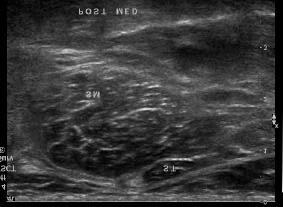 large Sudden severe pain if rupture Ultrasound Location: between the medial