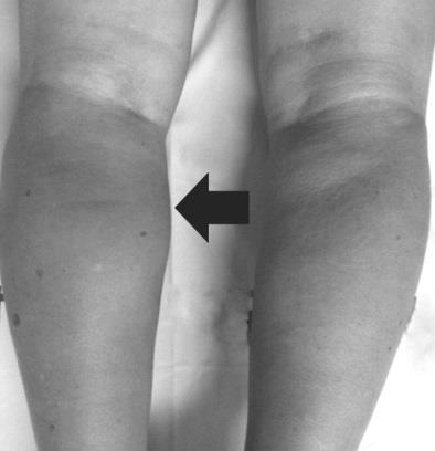 delayed. A plain X-ray of the left leg revealed Kellgren-Lawrence grade 4 osteoarthritis of the knee joint and increased soft tissue density AL-SADEK T., et al.