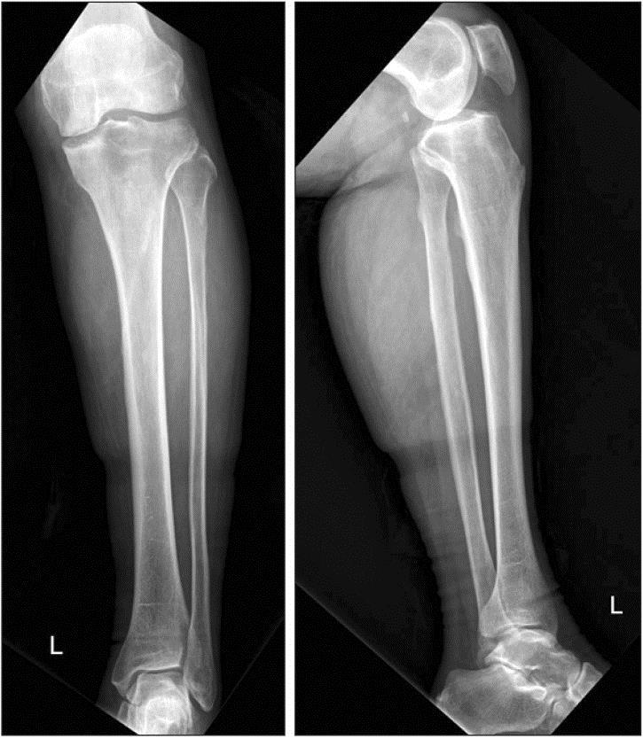 Plain radiographs of the left leg show severe osteoarthritis of the knee joint and elongated soft tissue density along the medial aspect of the proximal lower leg.