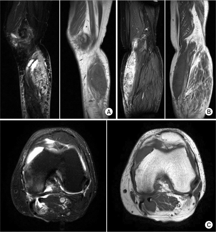 AL-SADEK T., et al. Figure 3. Magnetic resonance imaging of the left knee.