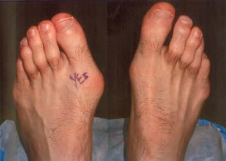 Traumatic Hallux Valgus Medial structures can
