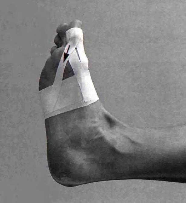 Taping of Toe Held in slight plantar flexion