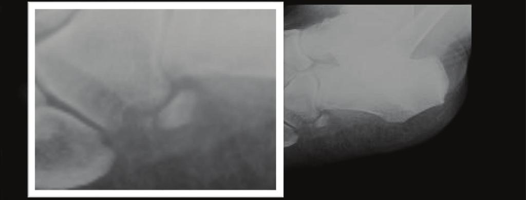 2 Case Reports in Radiology (a) (b) Figure 1: 60-year-old female plain film of the feet in an oblique view.