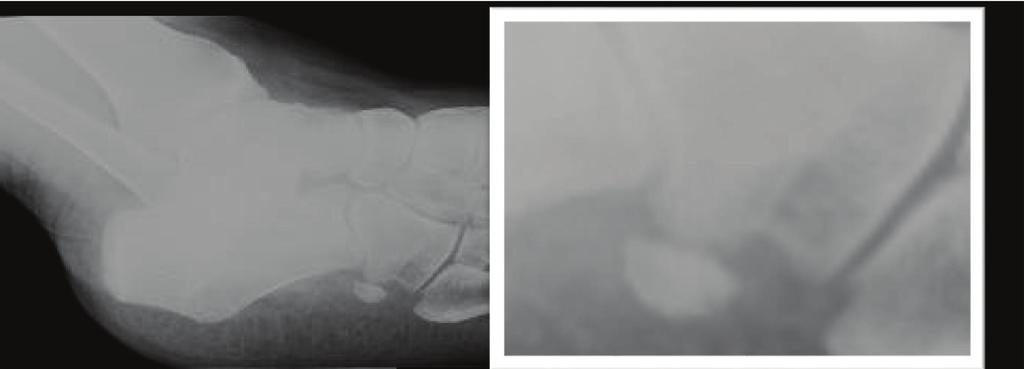 (b) Left foot: comparative contralateral side, showing a regular and complete os peroneum with regular contours and