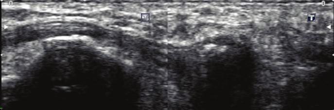 Case Reports in Radiology 3 (a) (b) Figure 3: 60-year-old female ultrasonography of the long axis of the peroneus longus tendon.