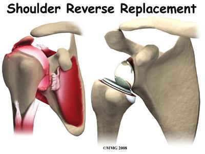 Introduction Shoulder joint replacement surgery (also called shoulder arthroplasty) can effectively ease pain from shoulder arthritis.