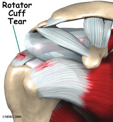 who are middle aged and older. Most rotator cuff repairs are successful, but in a portion of patients, the tendon has become so degenerated that the tendon can simply not be repaired.