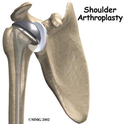 Patients with this type of arthritis would seem to be good candidates for a shoulder replacement, but replacing the shoulder in the typical fashion has not been successful.