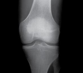 the moving surfaces. When you have OA this fluid becomes diseased and no longer protects the joint effectively.