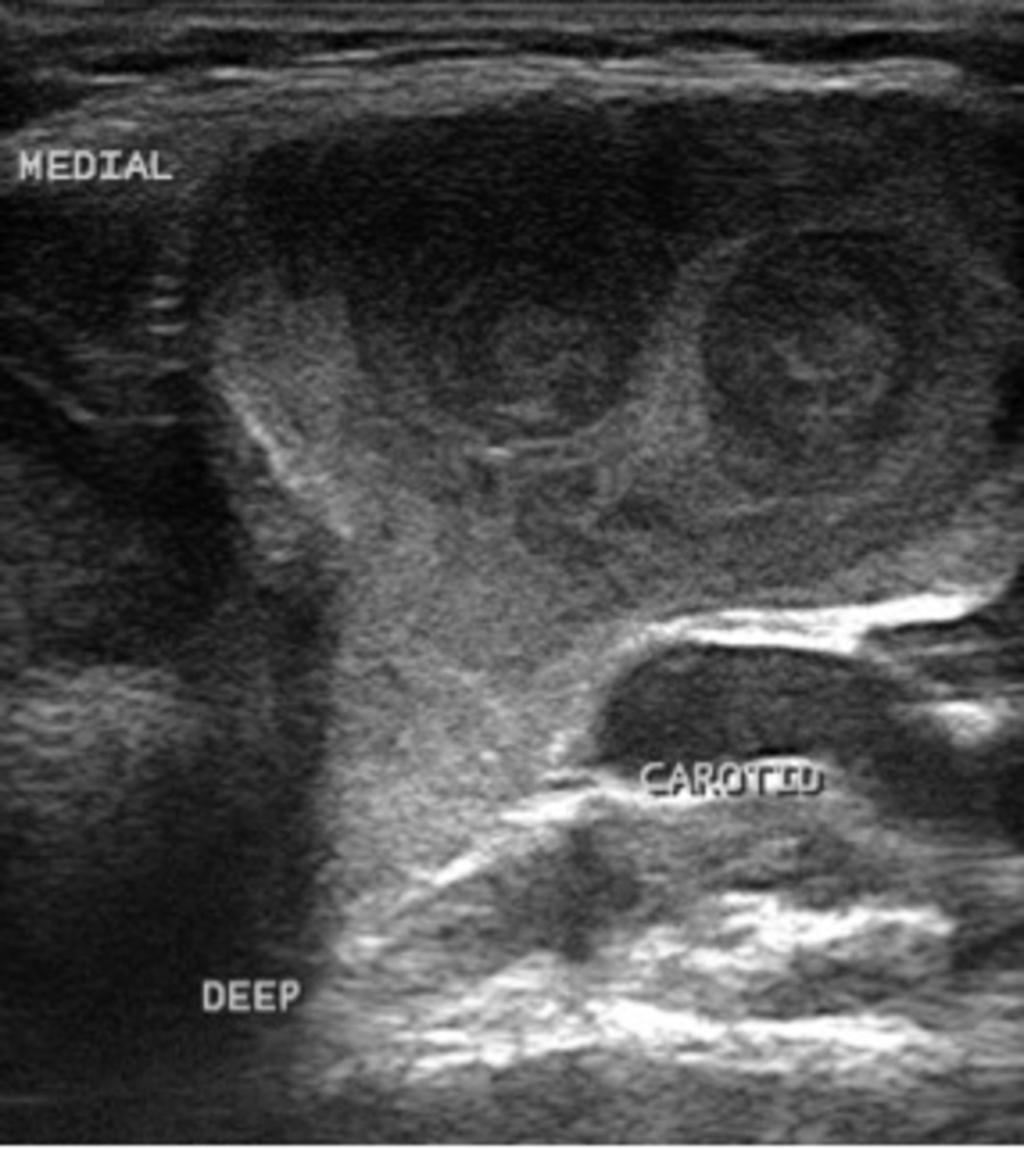 Fig. 7: Ultrasound image showing the anatomical relationship of the cyst to neighbouring structures and the swirling of contents within the cyst References: Department of Medical Imaging, Mater