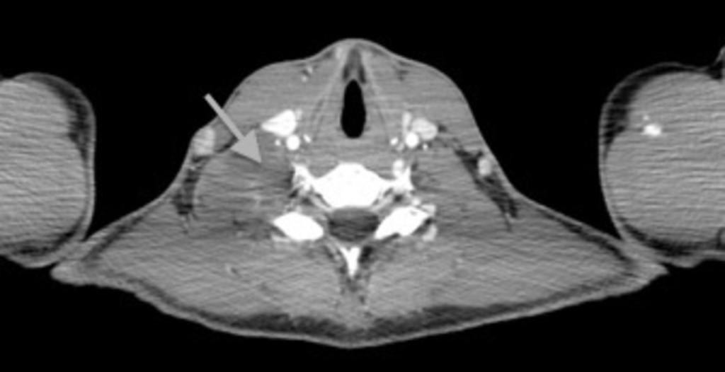 Fig. 8: Axial CT image showing the anterior and lateral extension of the cyst References: Department of Medical Imaging, Mater Dei Hospital, Malta 2013 Fig.