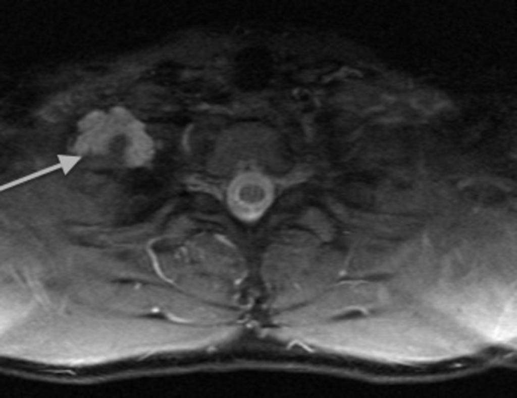 Fig. 10: Axial T2W MRI image showing the inferior extension of the cyst