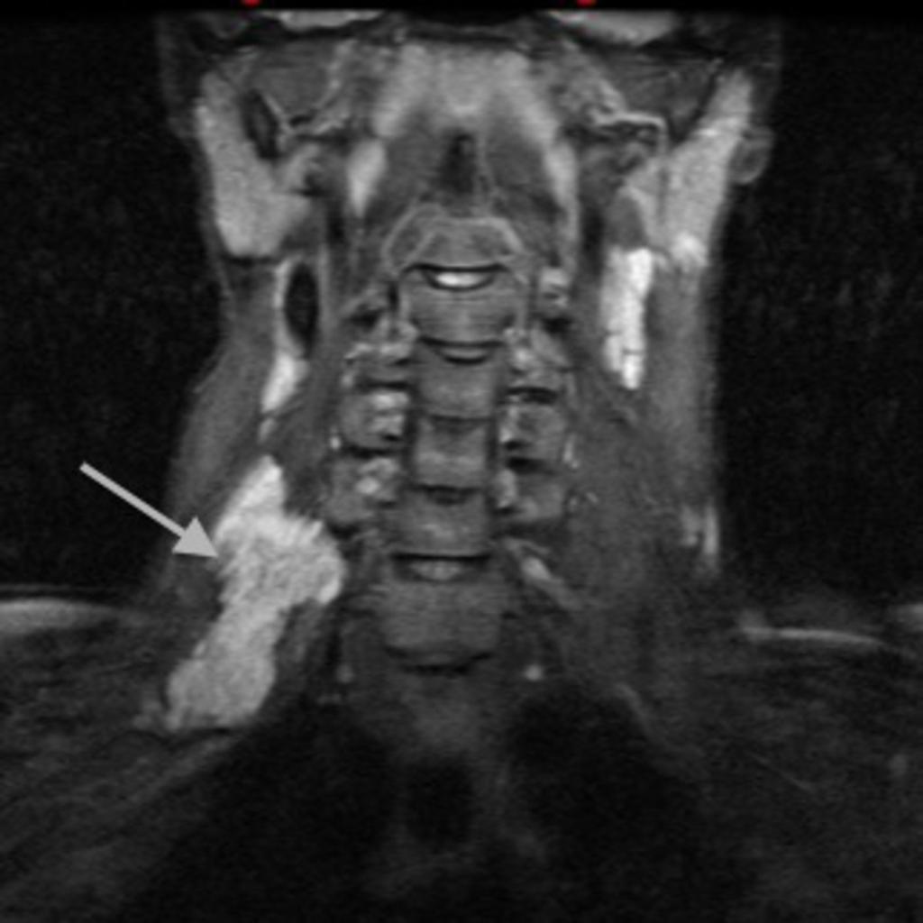 Fig. 11: Coronal T2W MRI image showing the inferior extension of the cyst References: Department of Medical Imaging, Mater Dei Hospital, Malta 2013 On CT / MRI, the beak sign refers to a curved rim