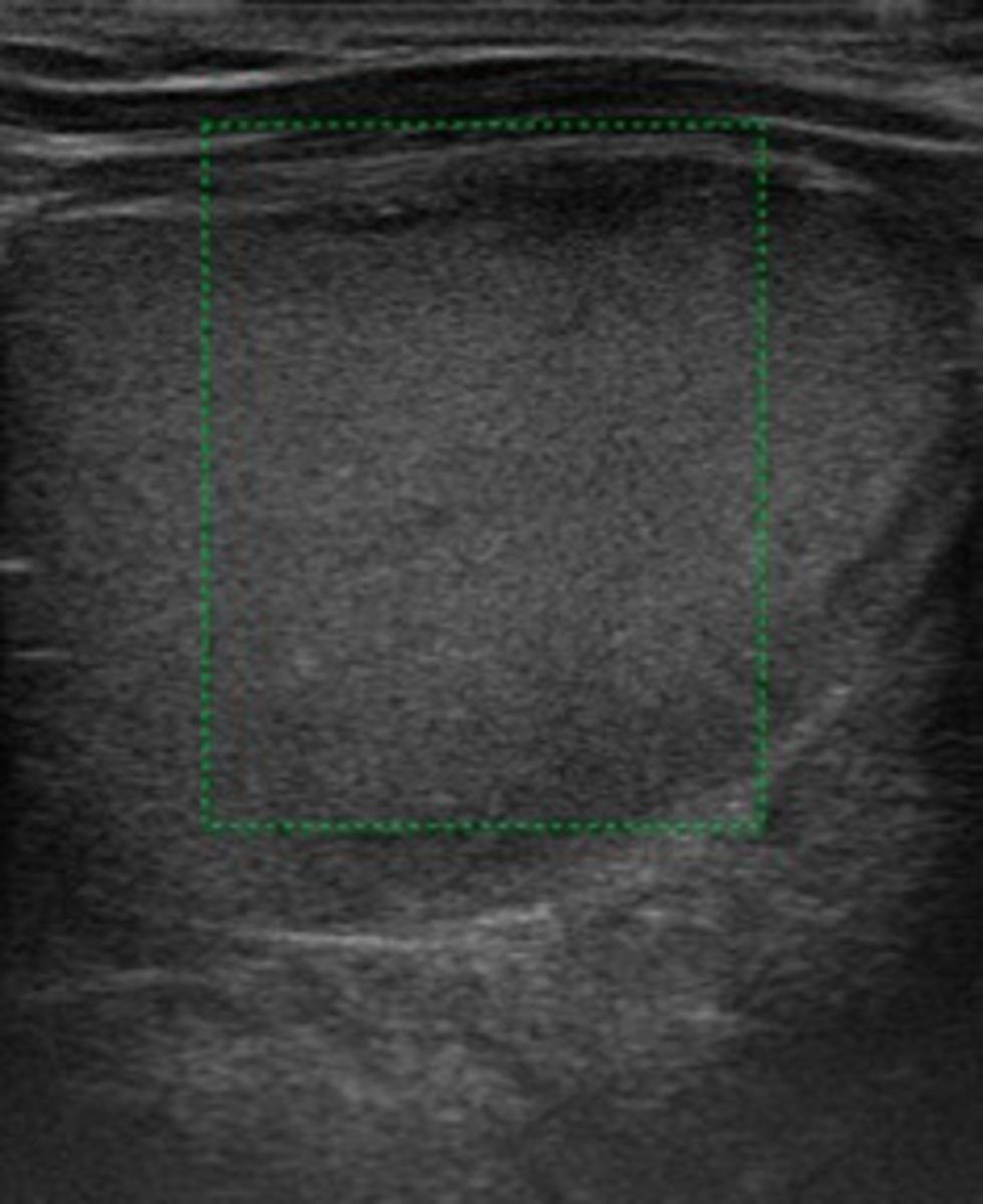 Fig. 1: Ultrasound image from a patient with a cyst full of debris and with no Doppler flow within