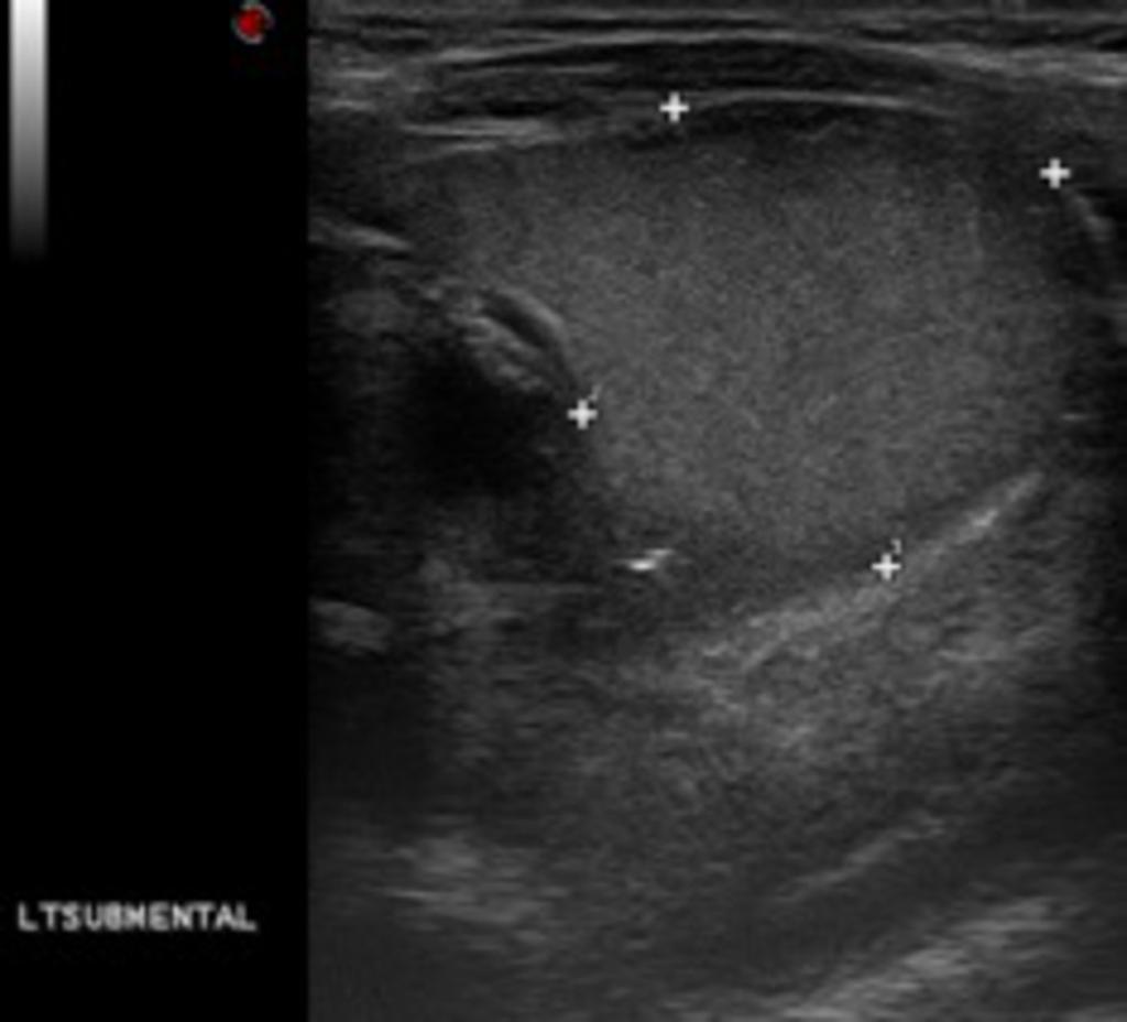 Fig. 2: Ultrasound image showing the cyst, typically situated in the submental region
