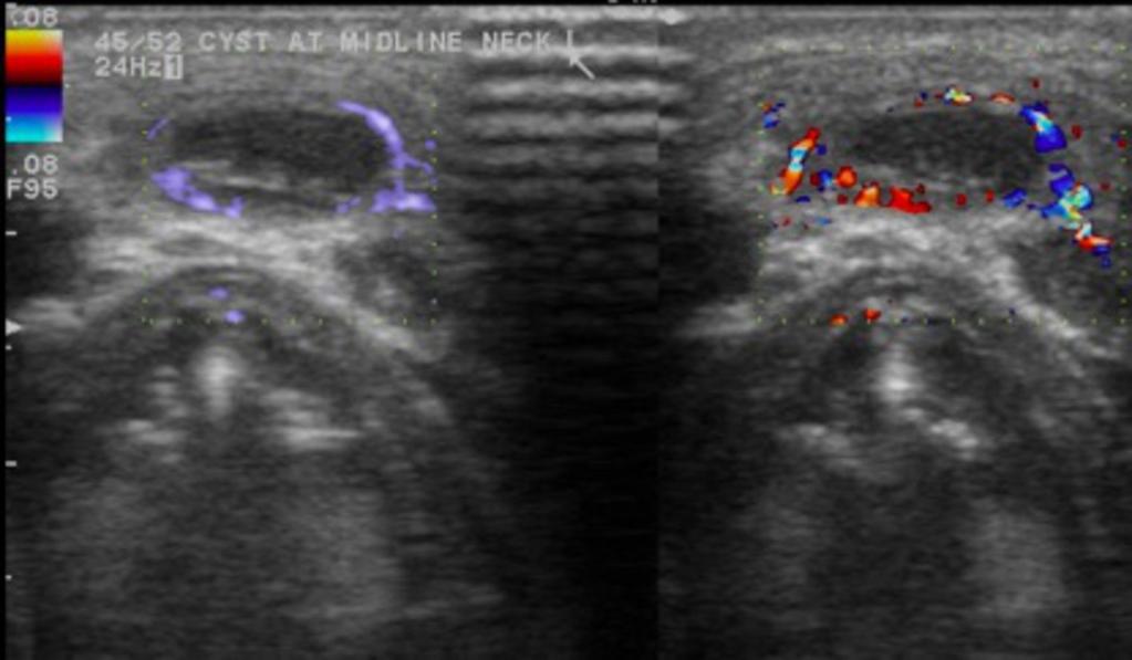 Fig. 3: Ultrasound image with colour Doppler showing debris in the dependent part of the cystic lesion and surrounding colour