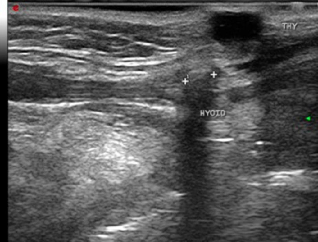 Fig. 4: Ultrasound image showing the location of this cyst in the infra-hyoid region. There is increased through transmission, confirming the fluid content of the lesion.