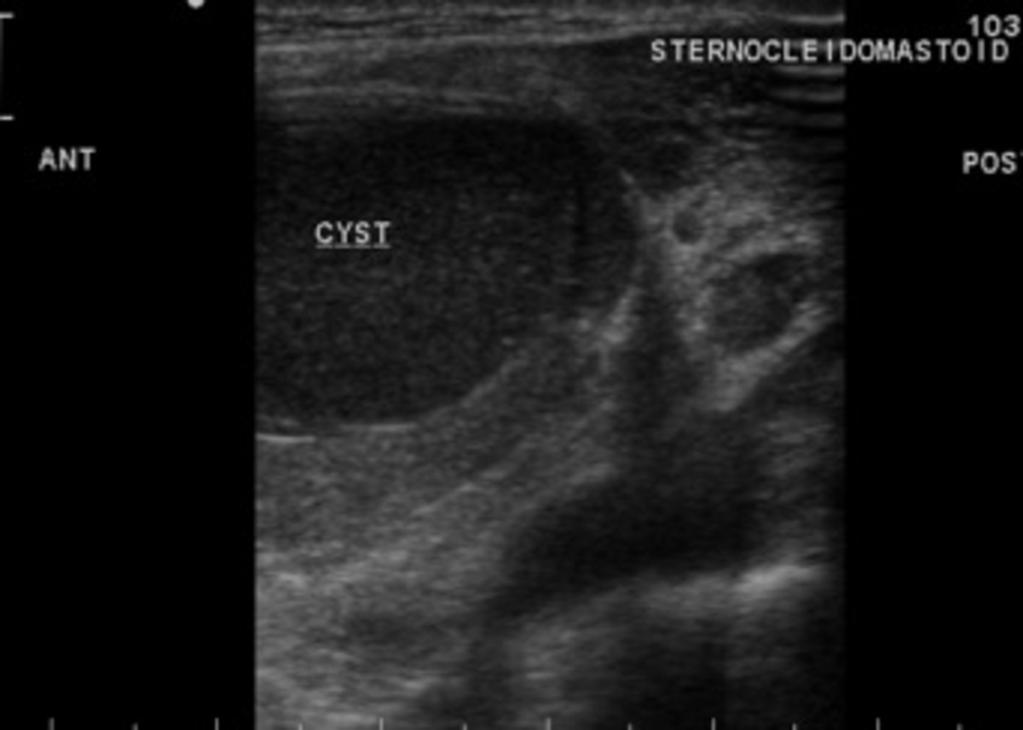 2. The most likely diagnosis of a midline neck mass which moves upwards on tongue protrusion in a child, is a thyroglossal duct cyst. These cysts arise th 3.