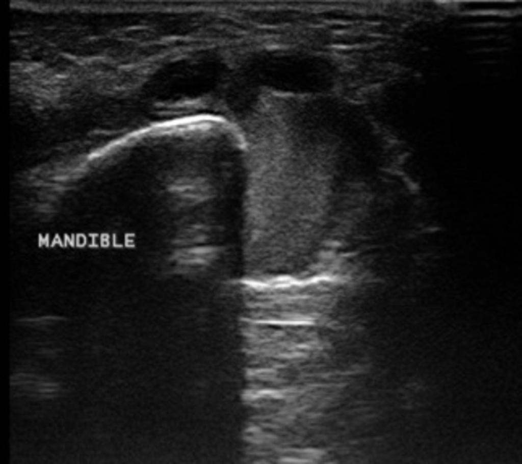 Fig. 5: Ultrasound image showing the cyst with echogenic debris within it, posterior to the right sternocleidomastoid muscle References: Department of Medical Imaging, Mater Dei