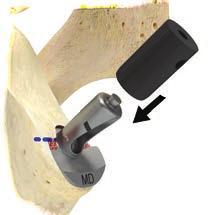pin onto the prepared glenoid (Figure 7a) taking care to