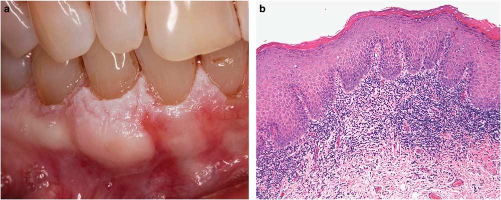 S64 Oral lichenoid lesions Figure 11 Clinical and histopathological features of proliferative verrucous leukoplakia in a 74-year-old non-smoking female.